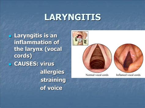 Ppt Diseases Of Pharynx And Larynx Powerpoint