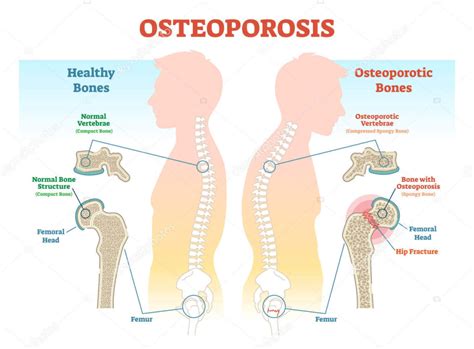 Osteoporosis Functional Medical Corporation
