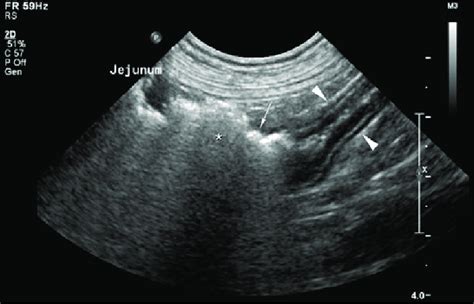 Abdominal Ultrasound Showing Abnormal Presence Of Presumed Intramural
