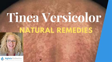 Natural Home Remedies For Tinea Versicolor Youtube