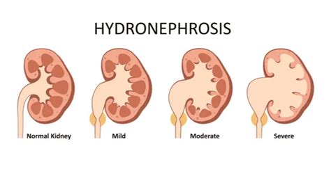 Hydronephrosis Kidney Swelling Symptoms And Causes Gleneagles Hospital