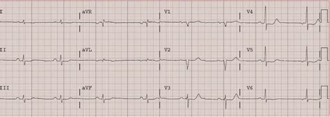 Dr Smiths Ecg Blog Pure Isolated Posterior Stemi Not So Rare