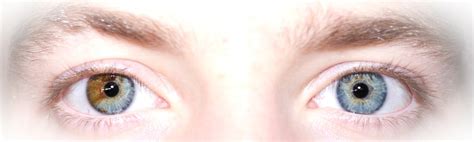 Heterochromia Iridum People With Two Different Colored Eyes Owlcation