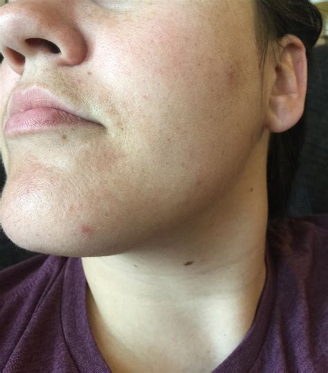 Routine Help Uneven Skin Tone Red Spots From Hormonal Acne Dull