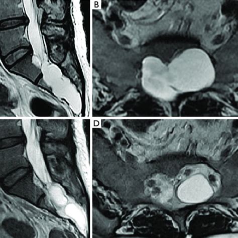 Magnetic Resonance Imaging Mri Showing Tarlov Cyst A T2 Weighted