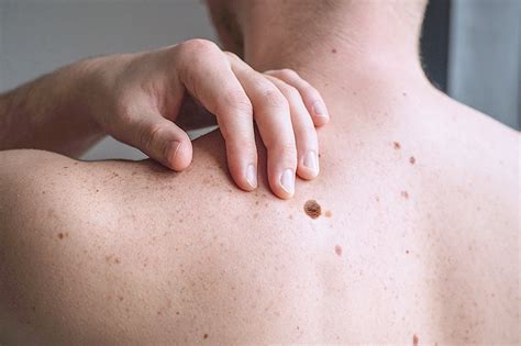How To Identify Melanoma Diagnosis Stages And Expert Treatment