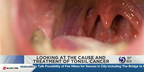Wvu Medicine Health Report Tonsil Cancer