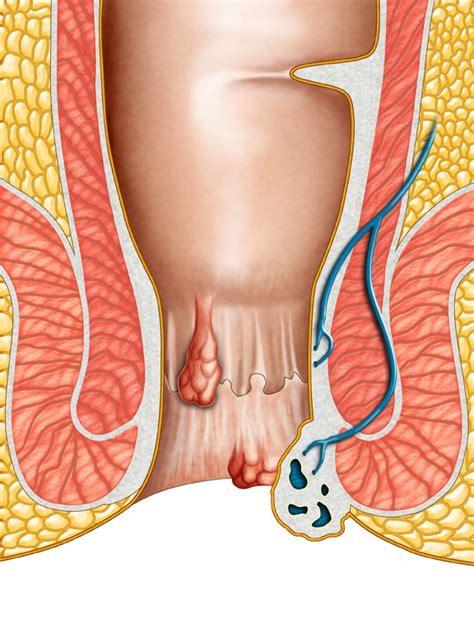 In a few people, rectal varices result from increased blood pressure in the portal vein, and these are distinct from internal hemorrhoids are located above the dentate line and are lined by rectal mucosa. Non-Surgical Natural Healing for Internal Hemorrhoids ...