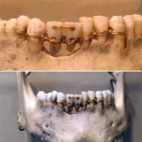 Adil 🇸🇩 عادل💢 On Twitter Rt Asiiceofhistory Dental Work Found On