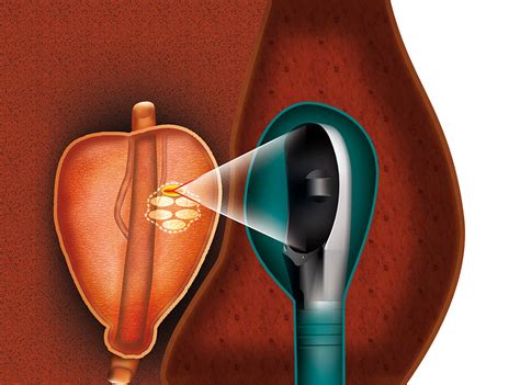 Focal High Intensity Focused Ultrasound Effective For Treating Prostate