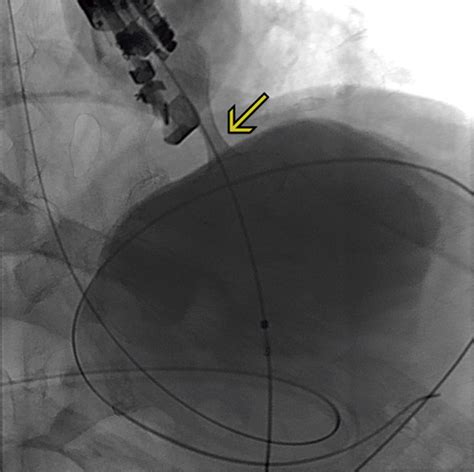 Relief Of Dysphagia Due To Advanced Achalasia By Endoscopic Creation Of