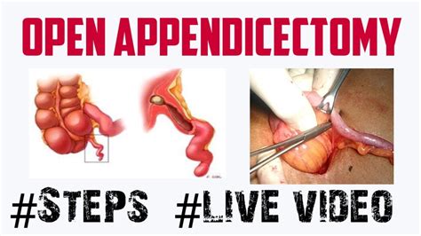open appendicectomy operative steps youtube