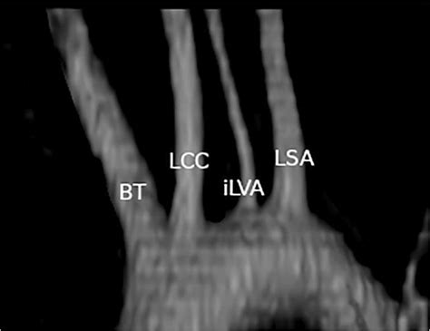 Bovine Aortic Arch With An Isolated Left Vertebral Artery Bt And Lcc