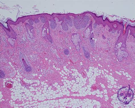Basal Cell Carcinoma Histopathology