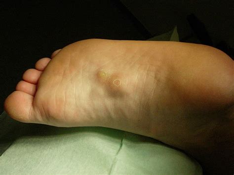 Ganglionic cysts are also known as bible cysts or gideon's cysts. Knotty lump & Bump On Bottom of Foot - What Are They ...