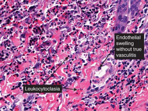 Perivascular Diffuse And Granulomatous Infiltrates Of The Reticular