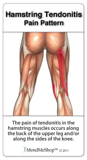 12 photos of the muscles and tendons of the leg. Hamstring Injury Information and Treatments