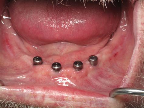 Bone Reduction Leveling For Dental Implants To Avoid A Bone Graft