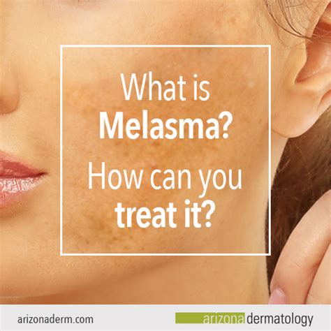 What Is Melasma How Can You Treat It