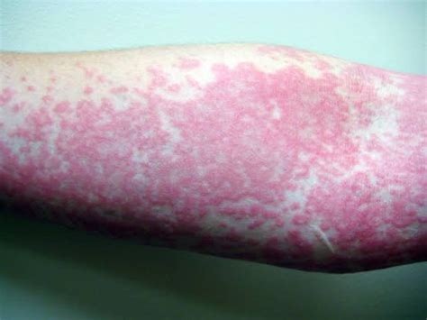 What Is Aquagenic Pruritus Quora