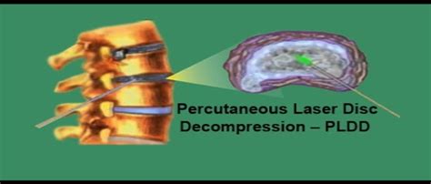 Percutaneous Laser Disc Decompression Pldd Orthopedic Centre