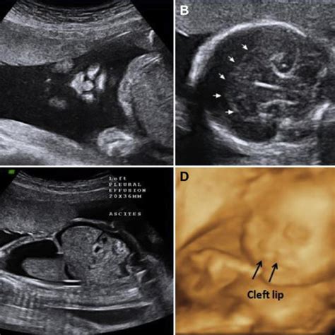 Prenatal Ultrasound A Premaxillary Dysgenesis Bilateral Cleft Lip