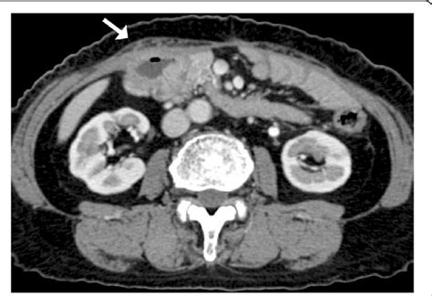Contrast Enhanced Abdominal Ct Scan Showed Wall Thickness With