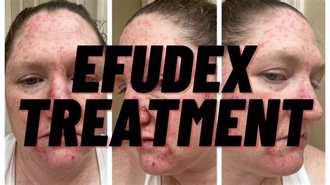 Showing You Every Day Of My Efudex Treatment Topical Chemotherapy
