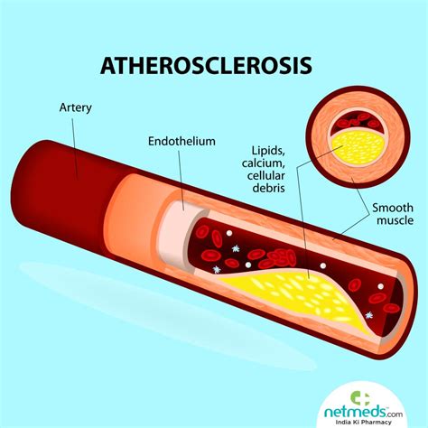 Atherosclerosis Causes Symptoms And Treatment Netmeds