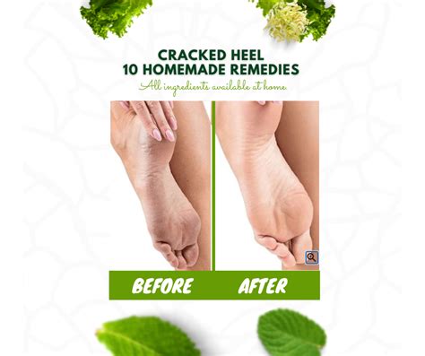 Cracked Heels 10 Homemade Remedies V Beautify