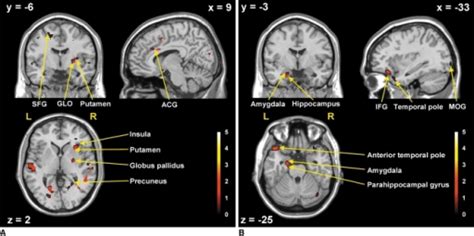 Brain Activation On Sagittal X Coronal Y Axial Z Open I