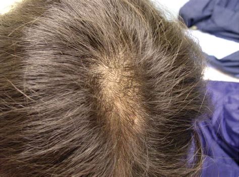 Hair Loss Visual Diagnosis And Treatment In Pediatrics 3 Ed