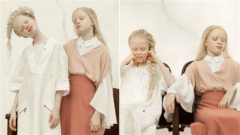Stunning Twin Teens With Albinism Take Modeling Industry By Storm Allure