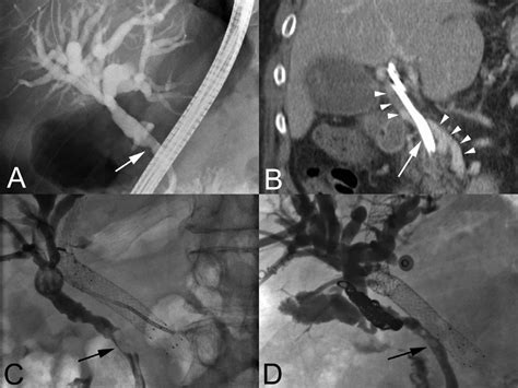 A Initial Cholangiogram Of A Narrowed Common Bile Duct Arrow B