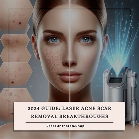 2024 Guide Laser Acne Scar Removal Breakthroughs