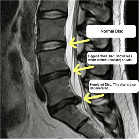 Treatment Options And Pathophysiology Of Degenerative Spine Disease