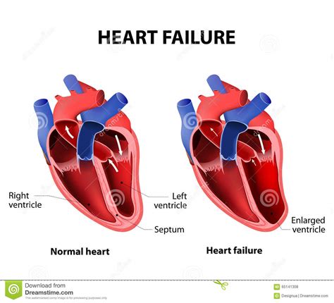 Heart Failure Stock Vector Image 65141308