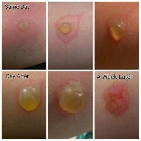 Second Degree Burn Healing Stages Hot Sex Picture