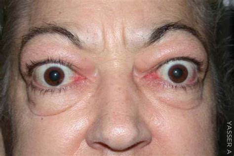 Thyroid Eye Disease And Its Effect On Facial Changes Thyroid Eye Disease