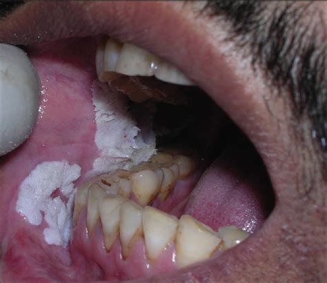 Oral Proliferative Verrucous Leukoplakia With Oral Submucous Fibrosis