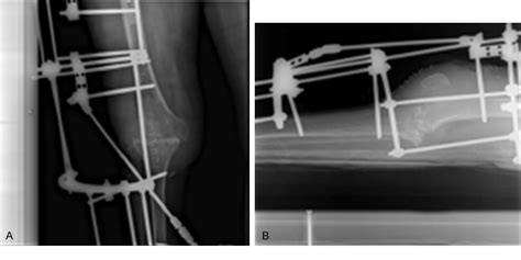 Figure 1 From Knee Arthrodesis With External Fixation In Infected