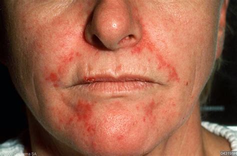 Skin Disease Types Seborrheic Dermatitis Hot Sex Picture