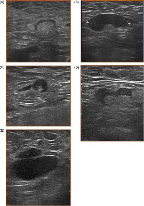 Pretreatment Axillary Ultrasonography And Core Biopsy In Patients With