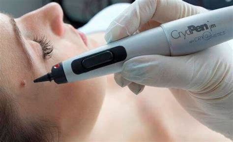 Cryopen Treatments Skin Secrets Beauty Clinic Pudsey Leeds