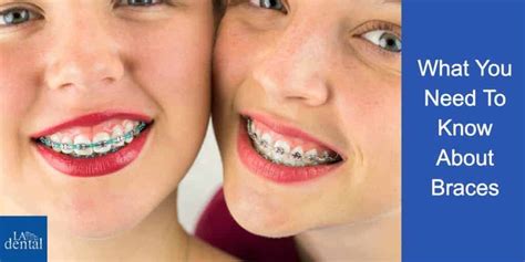 What You Need To Know About Braces La Dental Clinic