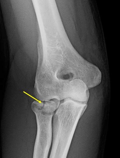 Radial Head Fracture Radiology Cases