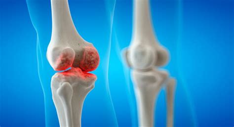 Complicaciones De La Artritis Reumatoide Salud Al Día