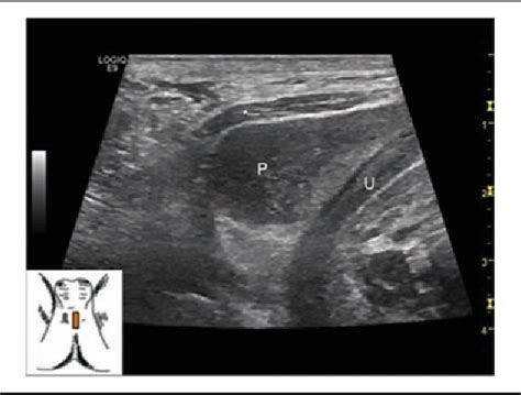 Pelvic Ultrasound For Men