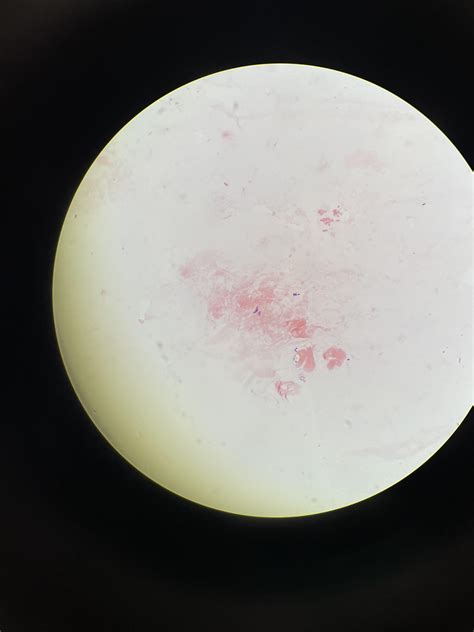 Gram Stained Sputum With Negative And Positive Rods Rmicrobiology
