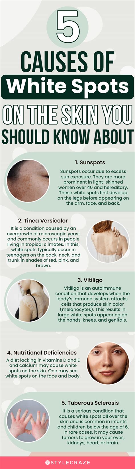 White Spots On Skin Causes And How To Get Rid Of Them Beauty Lovers